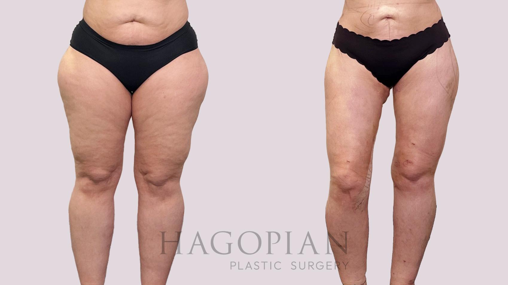 Before & After Thigh Lift Case 200 Front View in Atlanta, GA