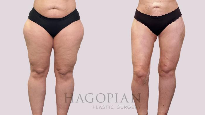 Before & After Thigh Lift Case 200 Front View in Atlanta, GA