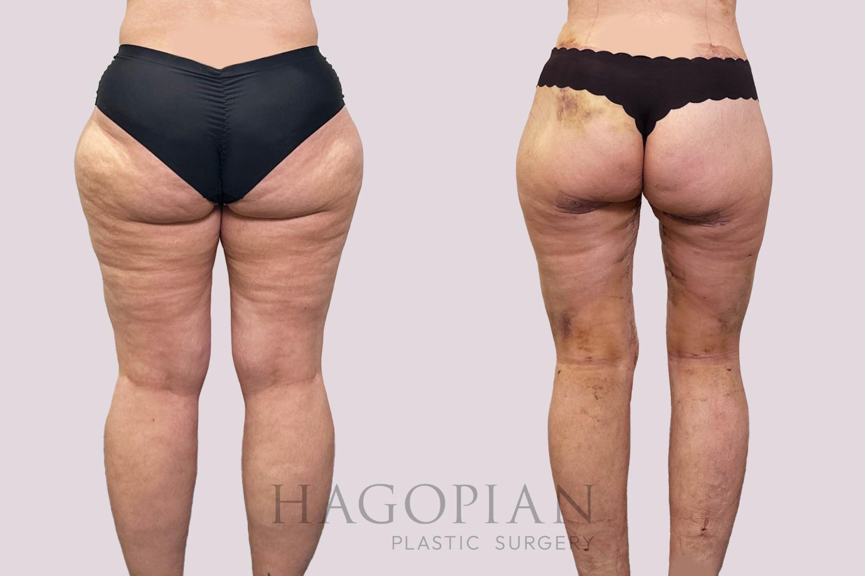 Before & After Thigh Lift Case 200 Left Side View in Atlanta, GA