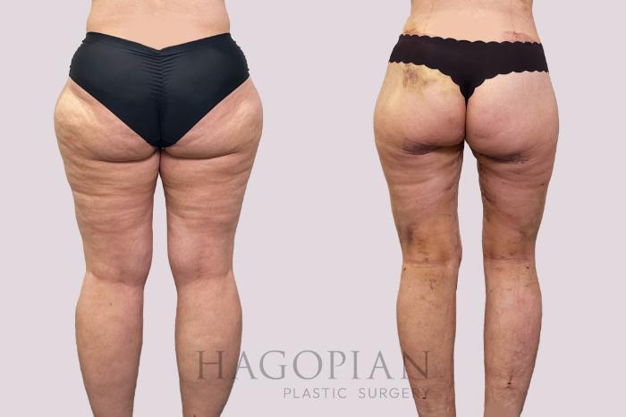 Before & After Thigh Lift Case 200 Left Side View in Atlanta, GA