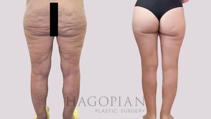 Before & After Thigh Lift Case 206 Back View in Atlanta, GA