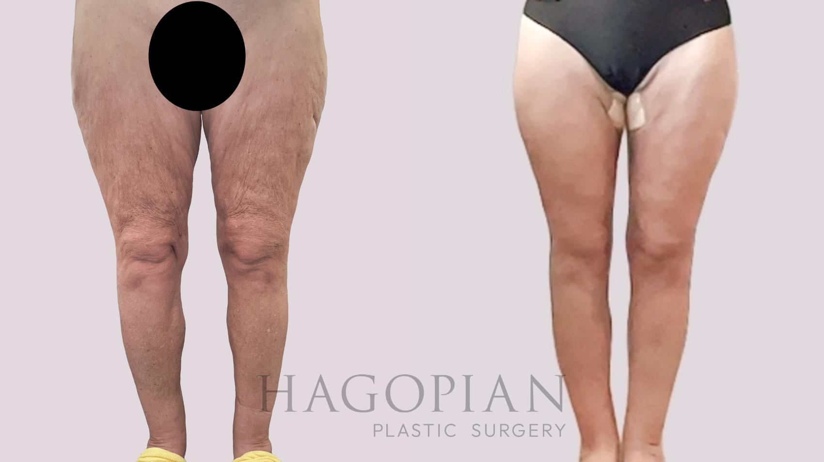 Before & After Thigh Lift Case 206 Front View in Atlanta, GA