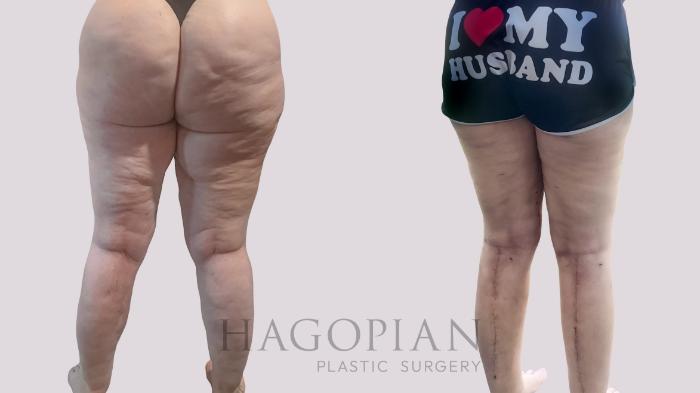 Before & After Thigh Lift Case 207 Back View in Atlanta, GA