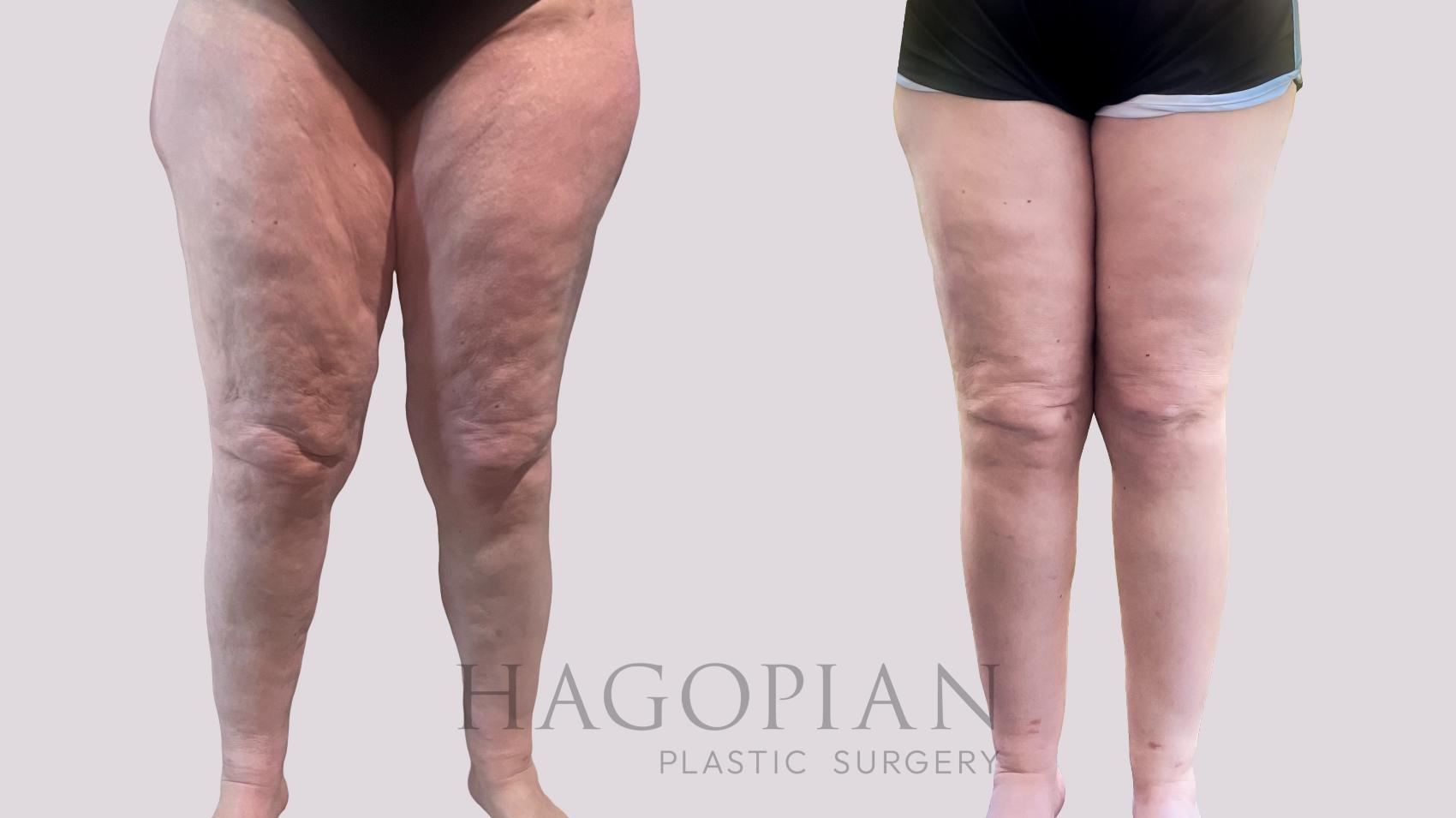 Before & After Thigh Lift Case 207 Front View in Atlanta, GA