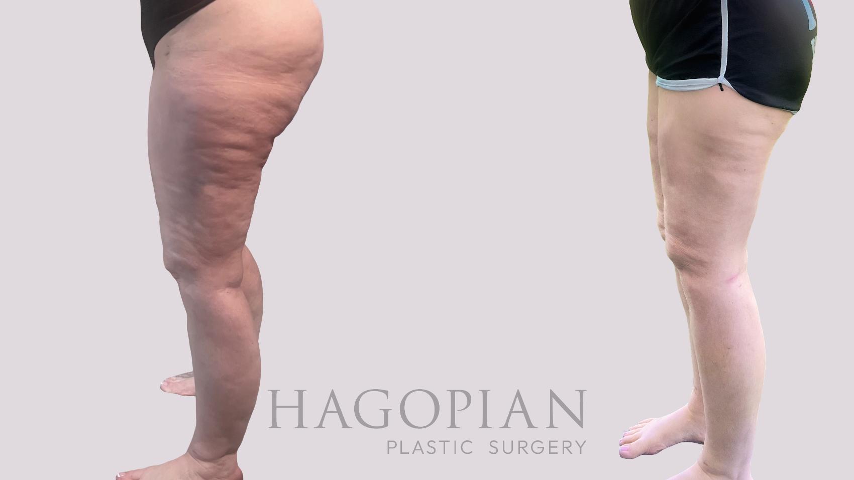 Before & After Thigh Lift Case 207 Left Side View in Atlanta, GA