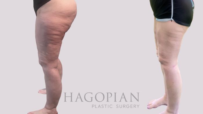 Before & After Thigh Lift Case 207 Left Side View in Atlanta, GA