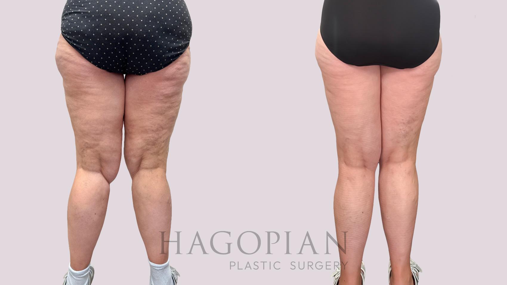 Before & After Thigh Lift Case 224 Back View in Atlanta, GA