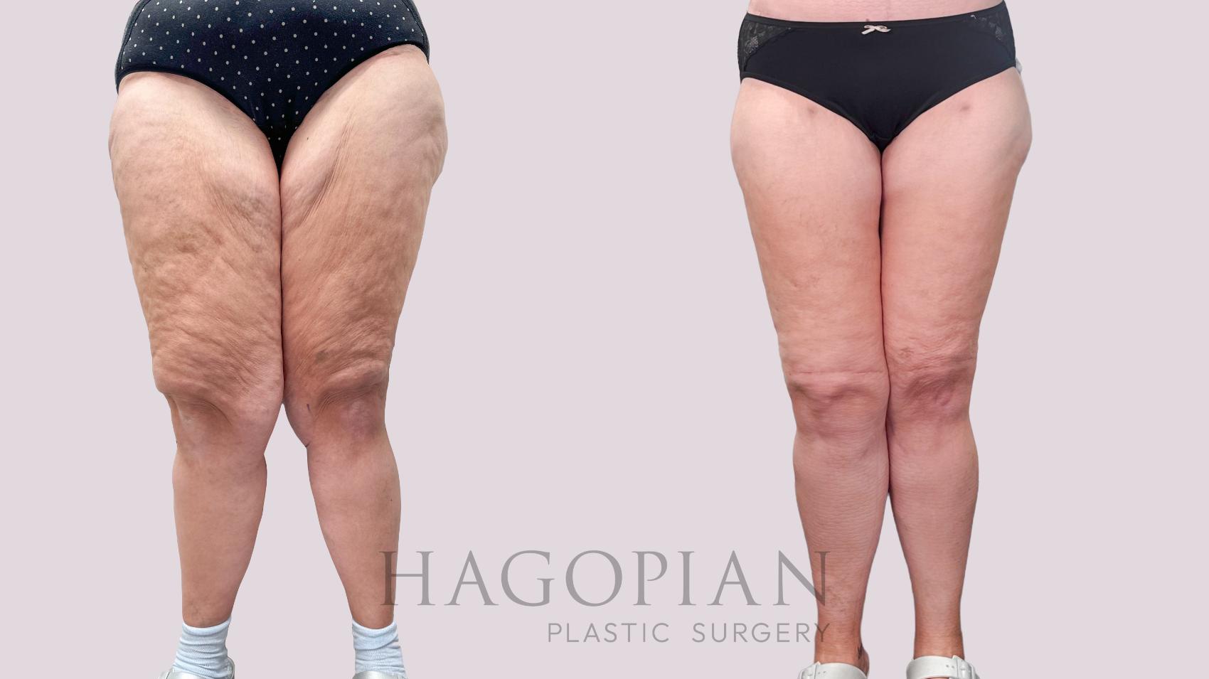 Before & After Thigh Lift Case 224 Front View in Atlanta, GA