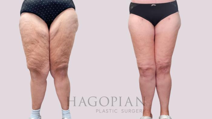Before & After Thigh Lift Case 224 Front View in Atlanta, GA