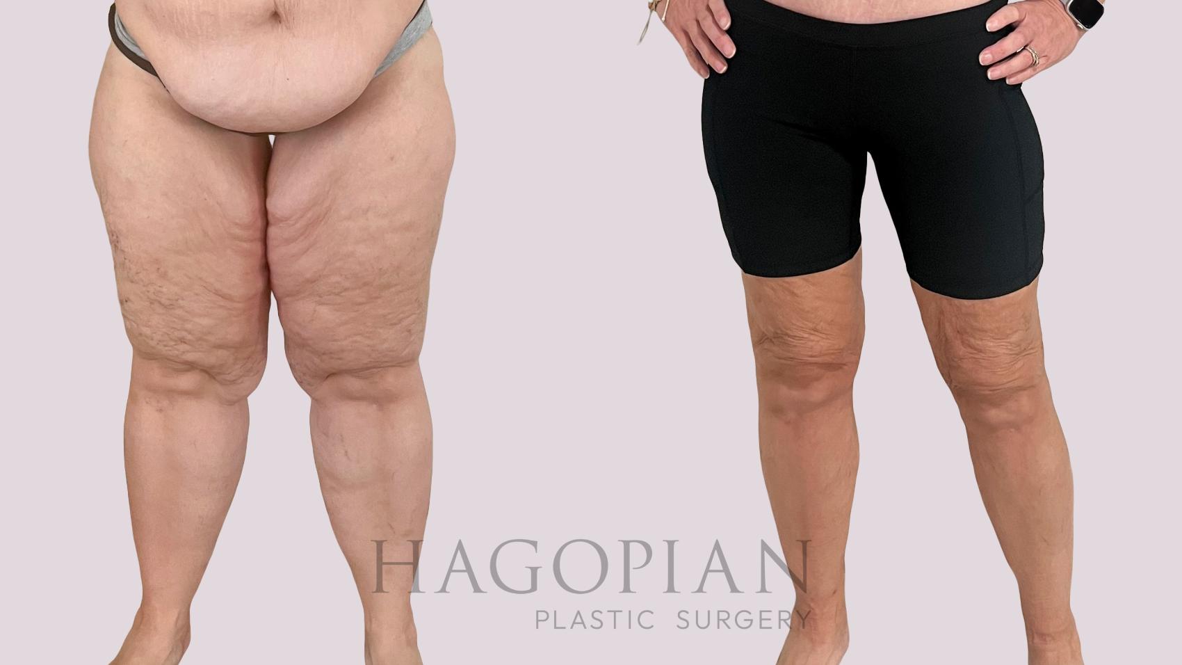 Before & After Thigh Lift Case 232 Front View in Atlanta, GA