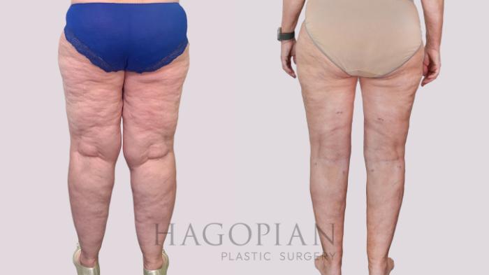 Before & After Thigh Lift Case 236 Back View in Atlanta, GA