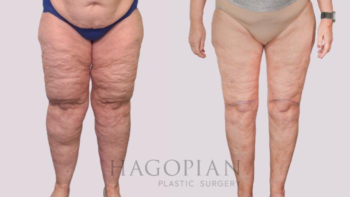 Before & After Thigh Lift Case 236 Front View in Atlanta, GA