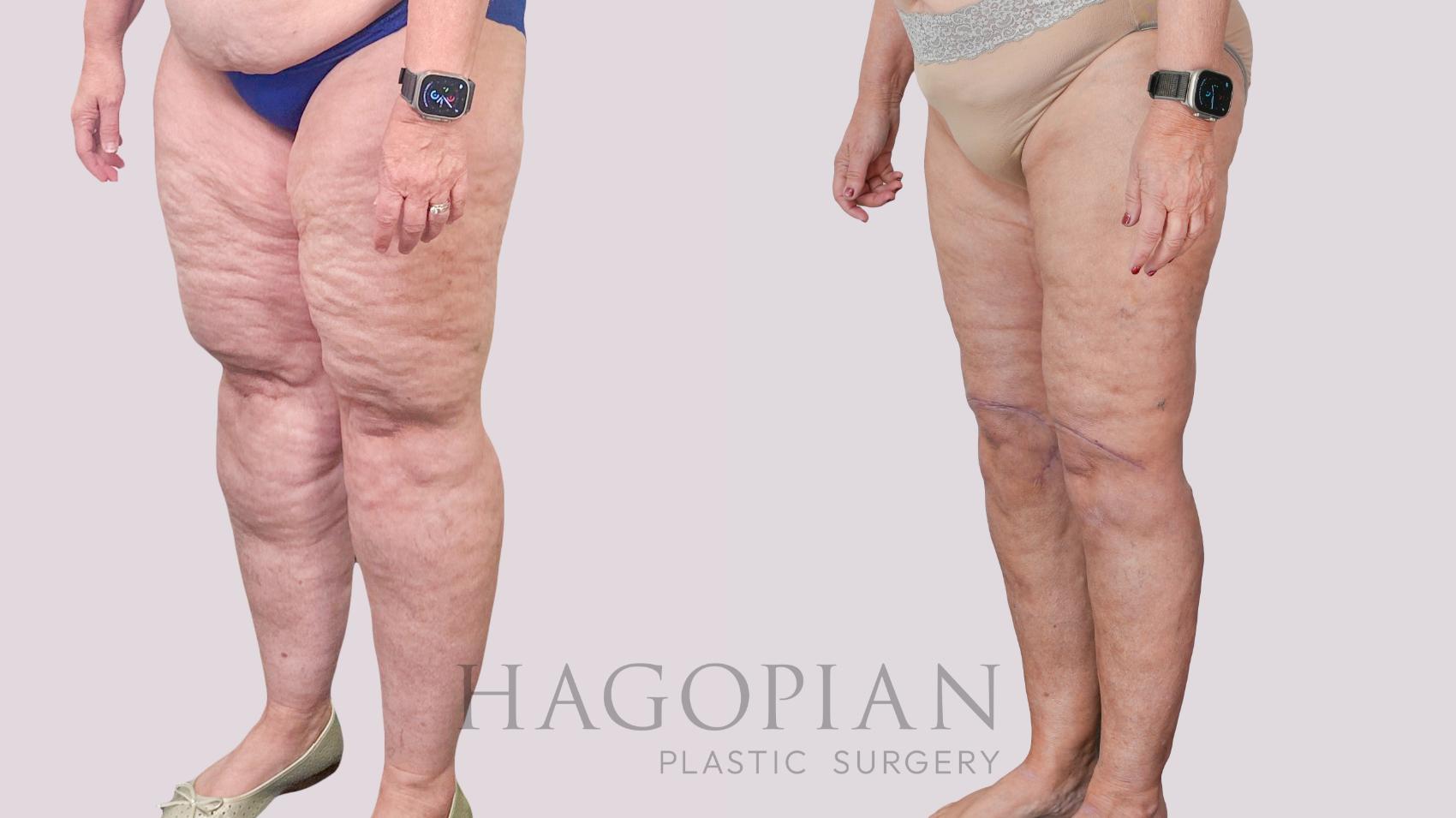 Before & After Thigh Lift Case 236 Left Oblique View in Atlanta, GA