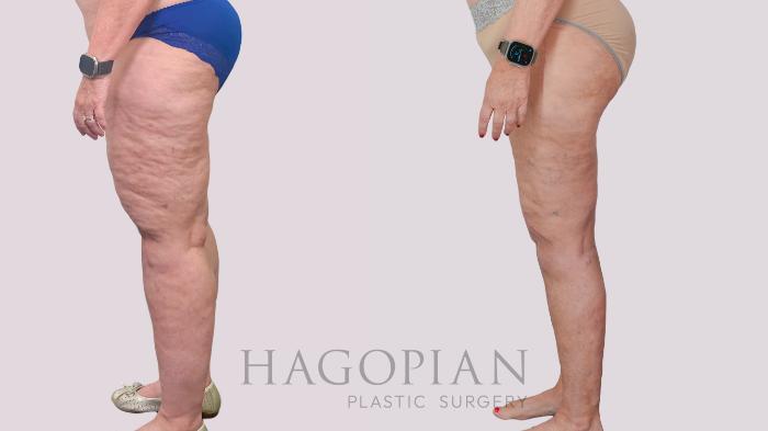 Before & After Thigh Lift Case 236 Left Side View in Atlanta, GA