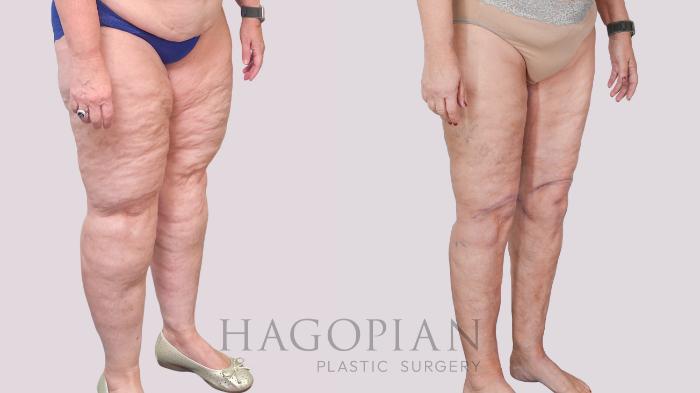 Before & After Thigh Lift Case 236 Right Oblique View in Atlanta, GA