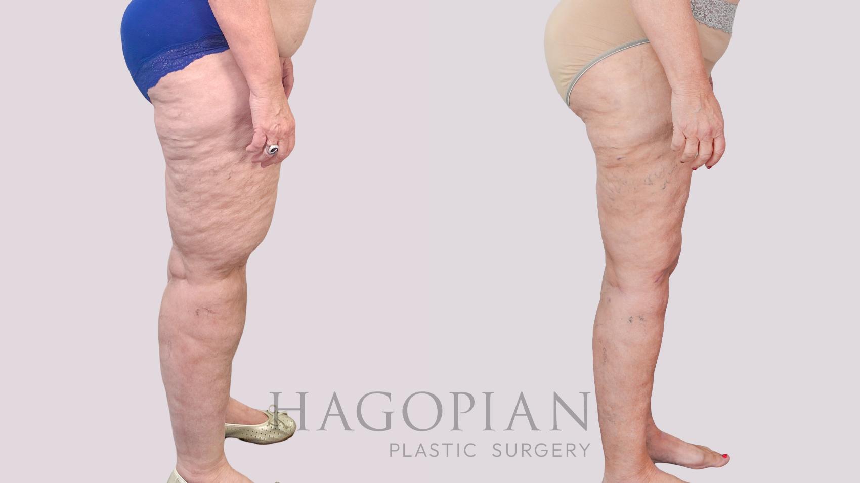 Before & After Thigh Lift Case 236 Right Side View in Atlanta, GA