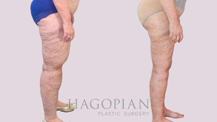 Before & After Thigh Lift Case 236 Right Side View in Atlanta, GA