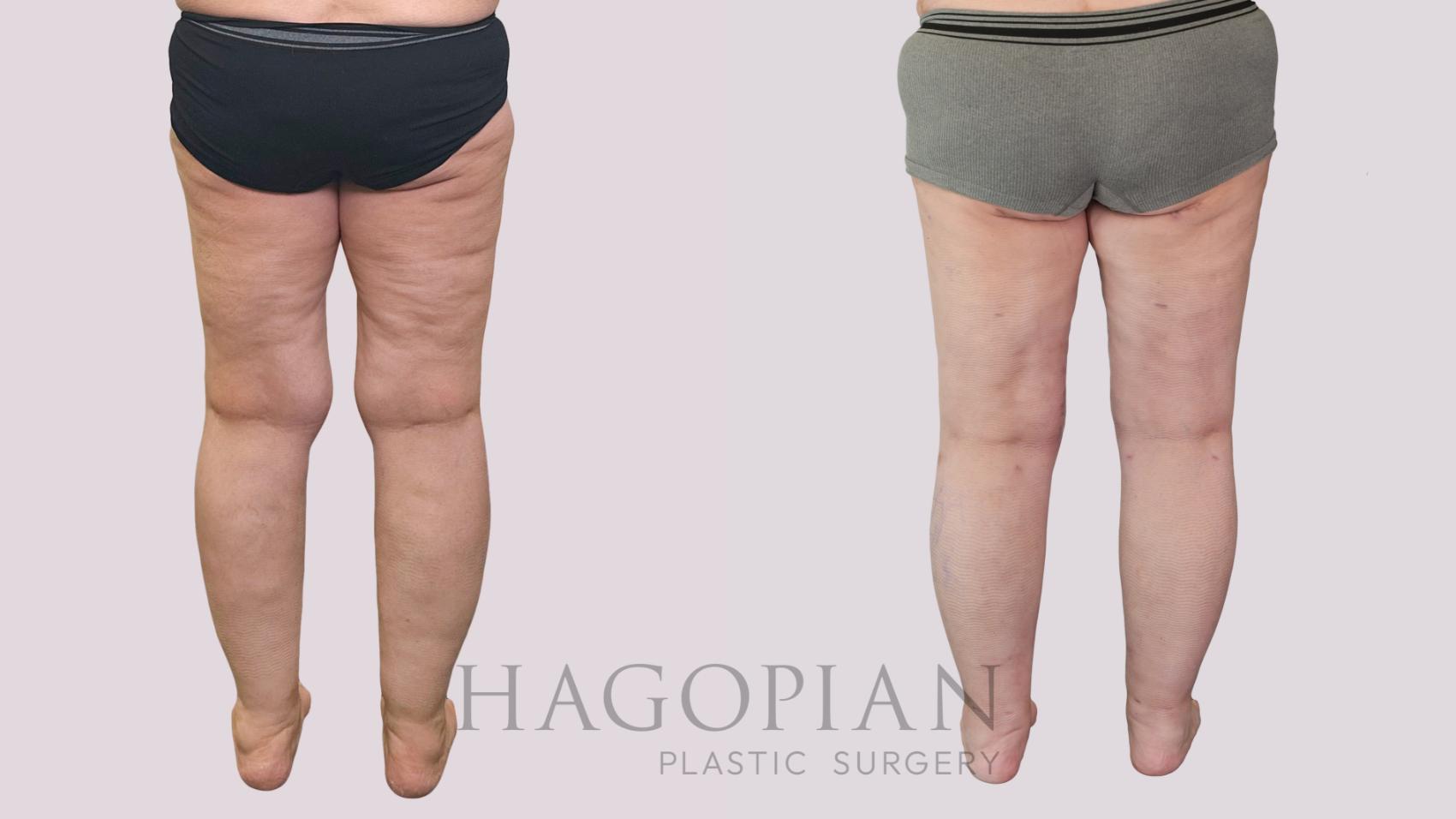 Before & After Thigh Lift Case 239 Back View in Atlanta, GA
