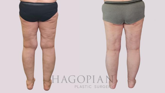 Before & After Thigh Lift Case 239 Back View in Atlanta, GA