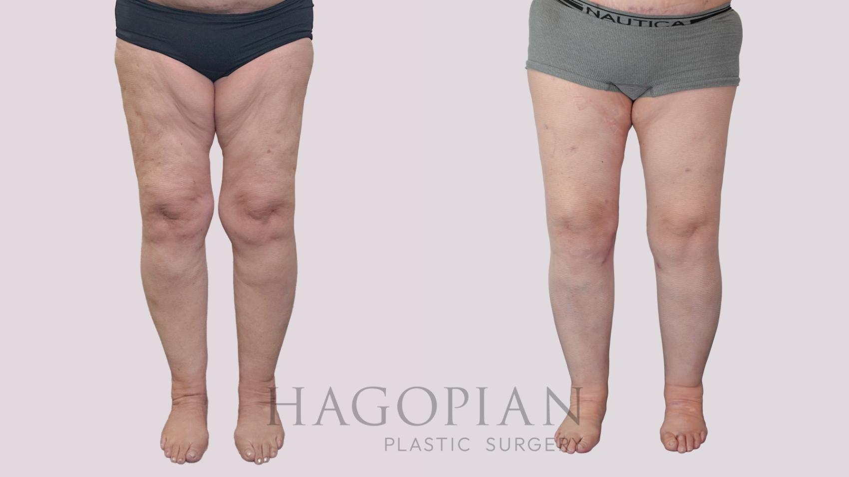 Before & After Thigh Lift Case 239 Front View in Atlanta, GA