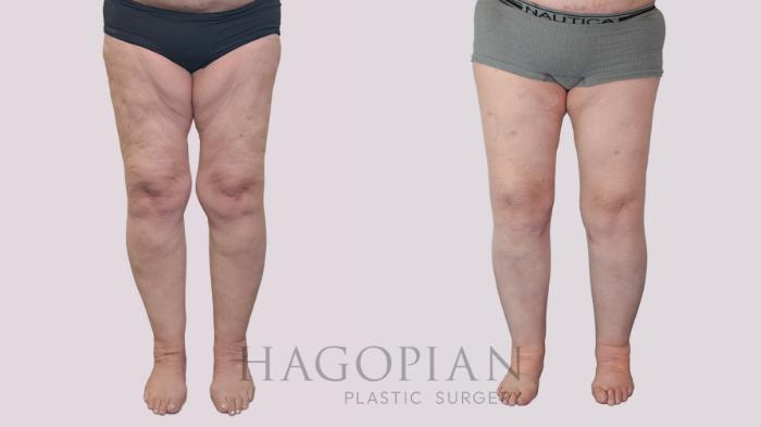 Before & After Thigh Lift Case 239 Front View in Atlanta, GA