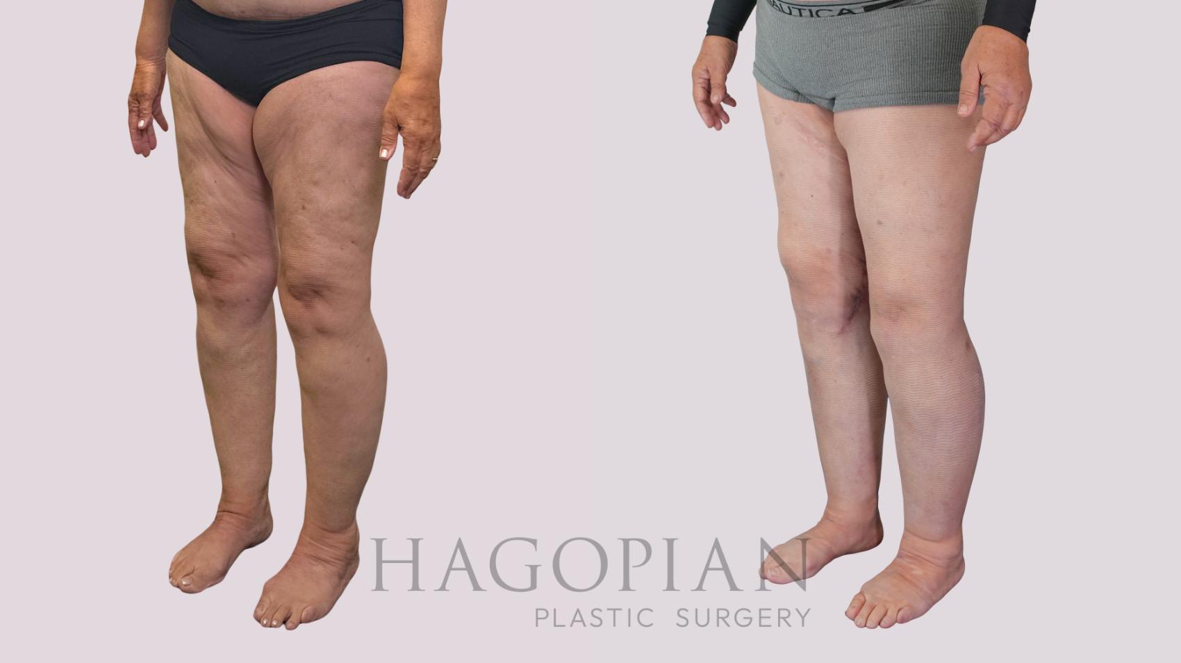 Before & After Thigh Lift Case 239 Left Oblique View in Atlanta, GA