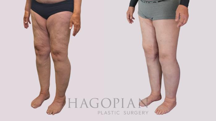 Before & After Thigh Lift Case 239 Left Oblique View in Atlanta, GA