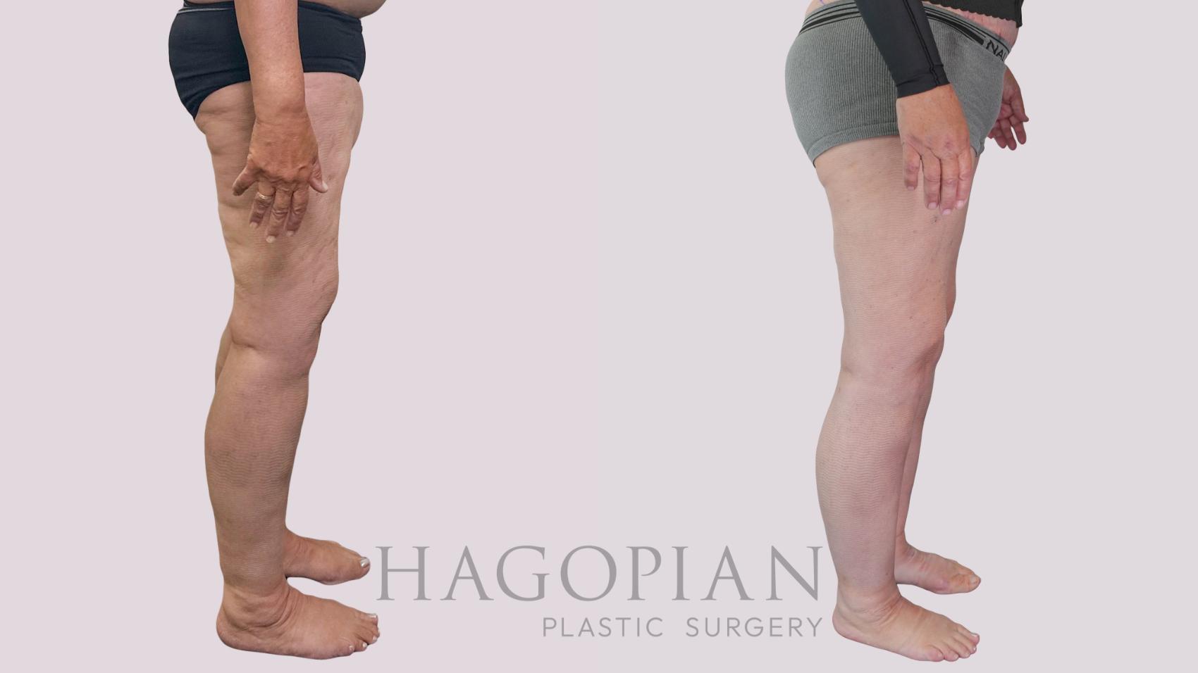 Before & After Thigh Lift Case 239 Right Side View in Atlanta, GA
