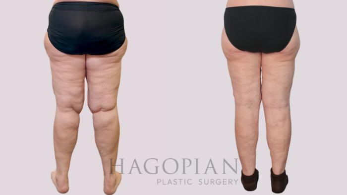 Before & After Thigh Lift Case 243 Back View in Atlanta, GA