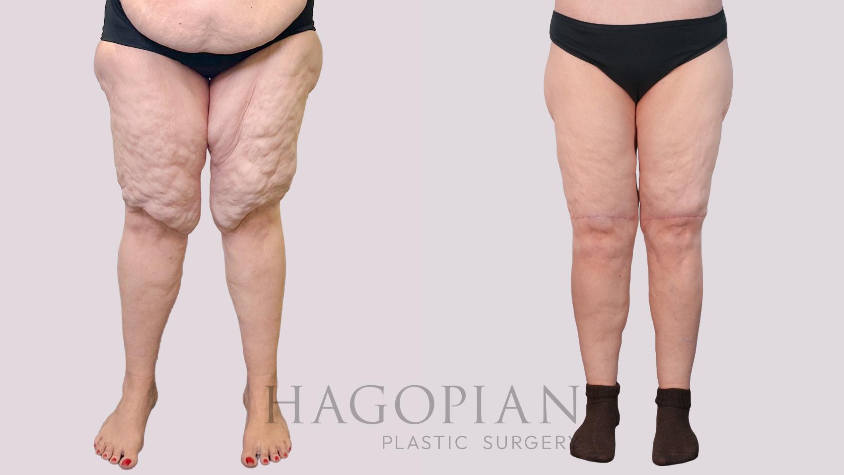 Before & After Thigh Lift Case 243 Front View in Atlanta, GA