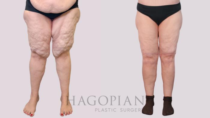 Before & After Thigh Lift Case 243 Front View in Atlanta, GA