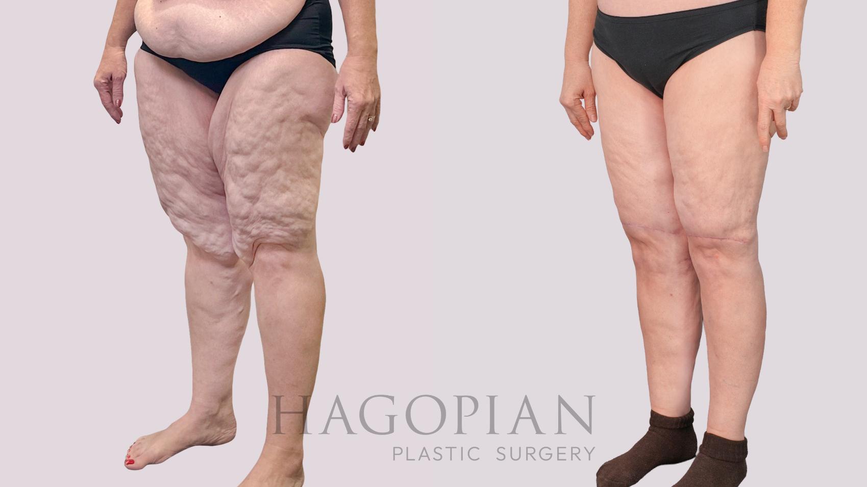 Before & After Thigh Lift Case 243 Left Oblique View in Atlanta, GA