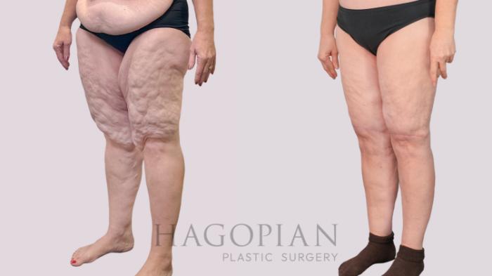 Before & After Thigh Lift Case 243 Left Oblique View in Atlanta, GA