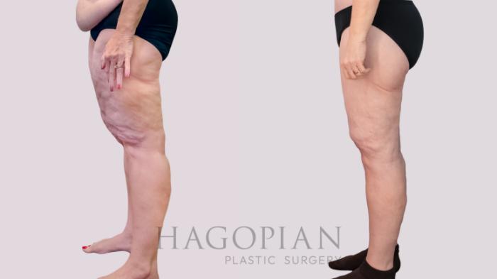 Before & After Thigh Lift Case 243 Left Side View in Atlanta, GA