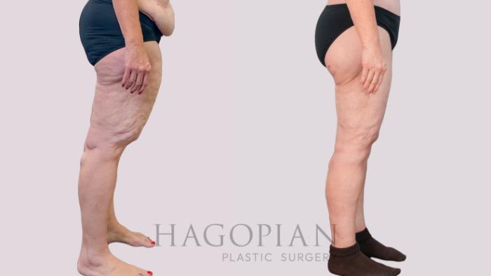 Before & After Thigh Lift Case 243 Right Side View in Atlanta, GA