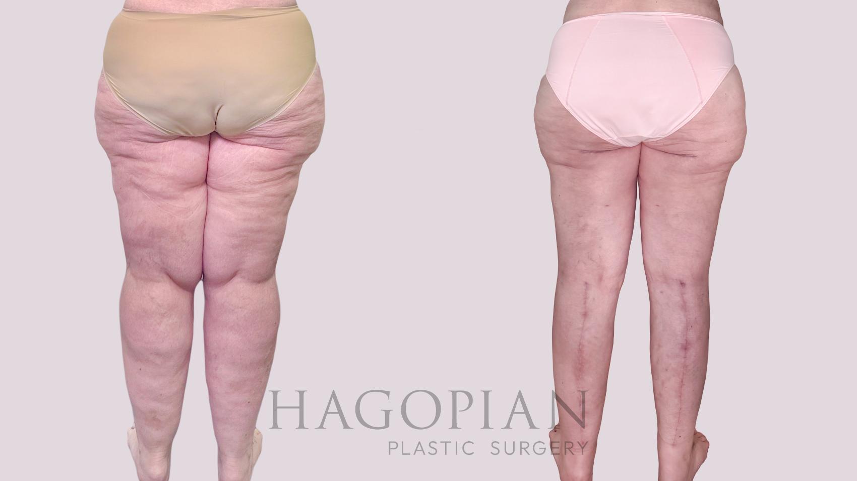 Before & After Thigh Lift Case 245 Back View in Atlanta, GA