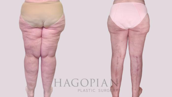 Before & After Thigh Lift Case 245 Back View in Atlanta, GA