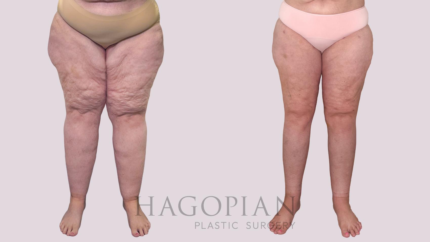 Before & After Thigh Lift Case 245 Front View in Atlanta, GA