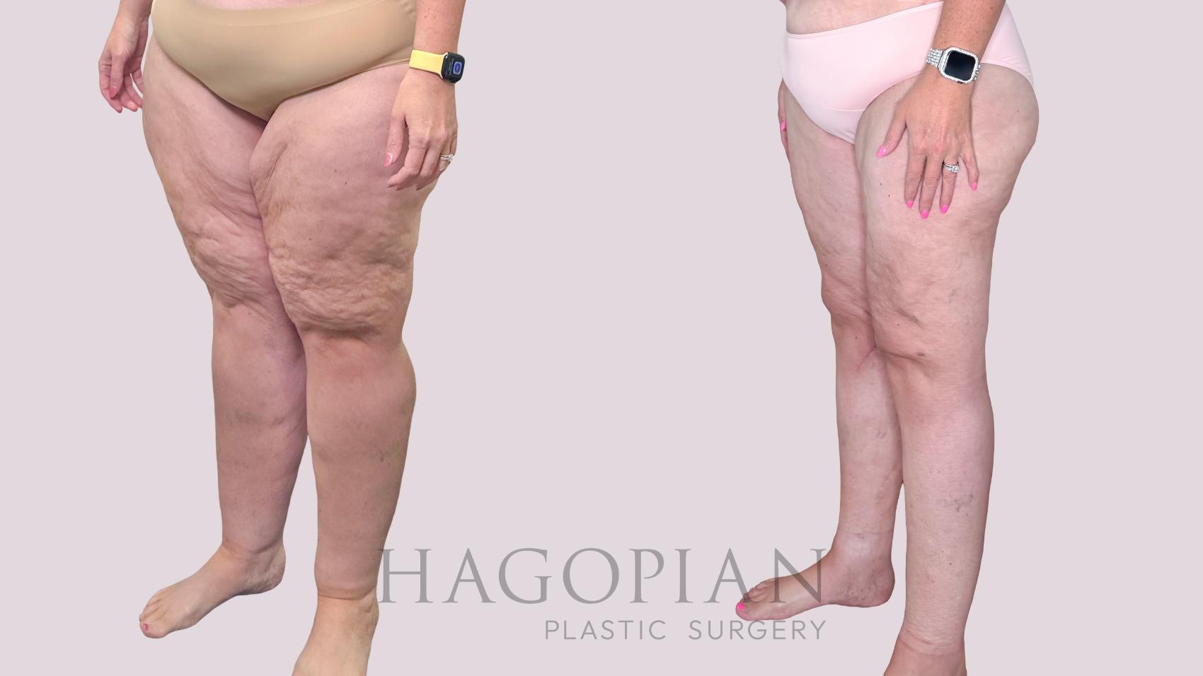 Before & After Thigh Lift Case 245 Left Oblique View in Atlanta, GA
