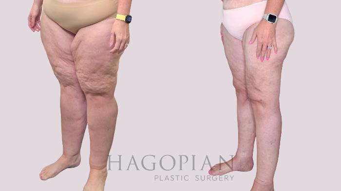 Before & After Thigh Lift Case 245 Left Oblique View in Atlanta, GA
