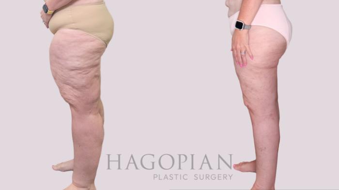 Before & After Thigh Lift Case 245 Left Side View in Atlanta, GA