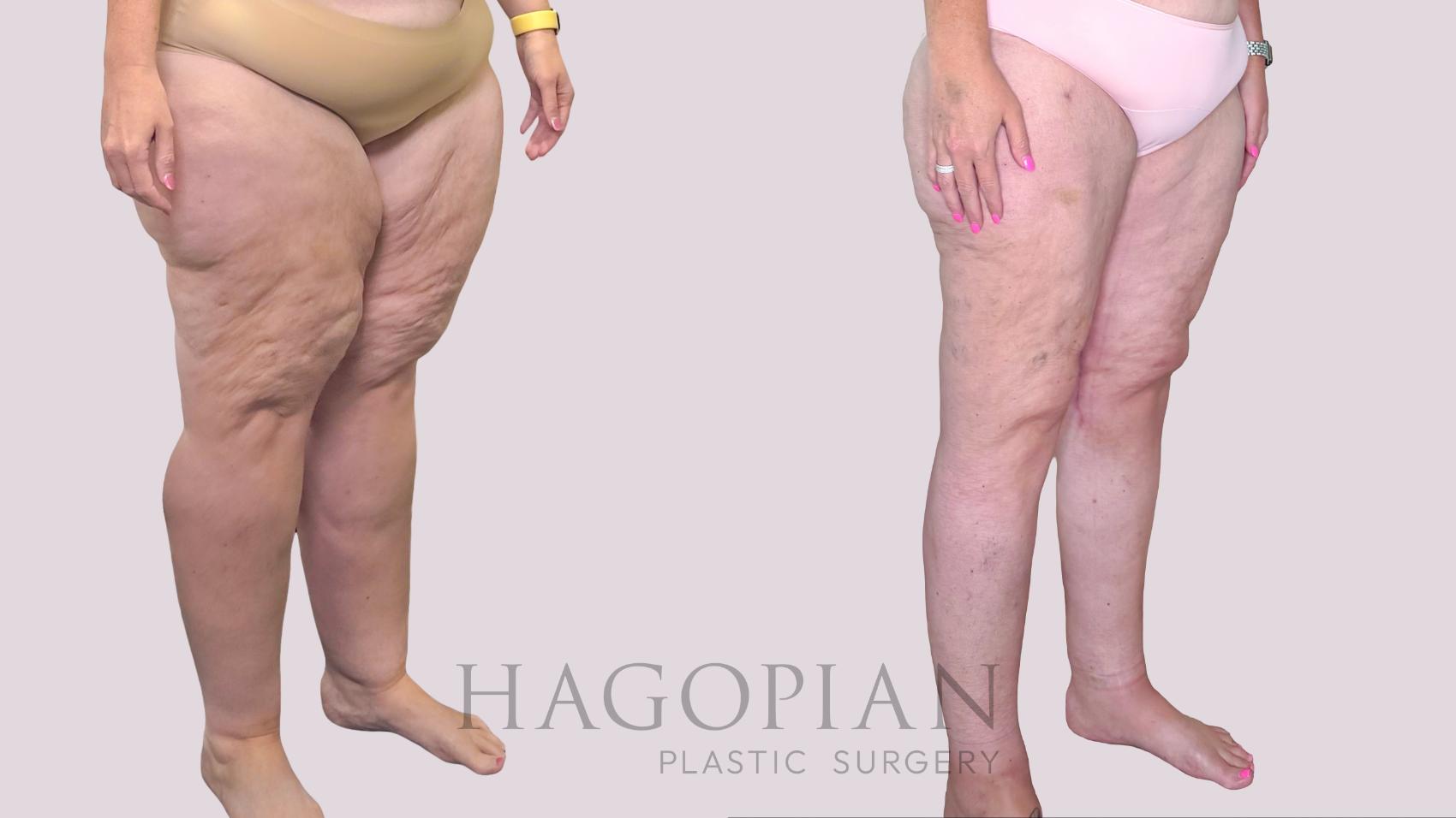 Before & After Thigh Lift Case 245 Right Oblique View in Atlanta, GA
