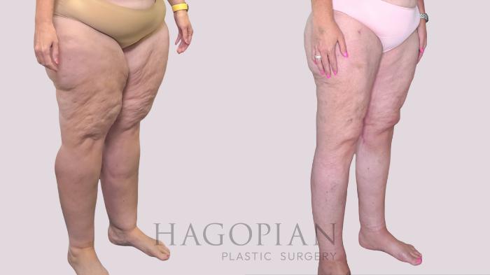 Before & After Thigh Lift Case 245 Right Oblique View in Atlanta, GA