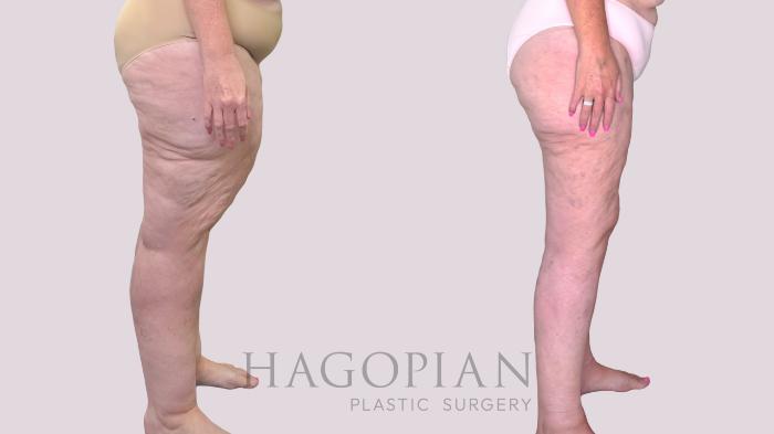 Before & After Thigh Lift Case 245 Right Side View in Atlanta, GA