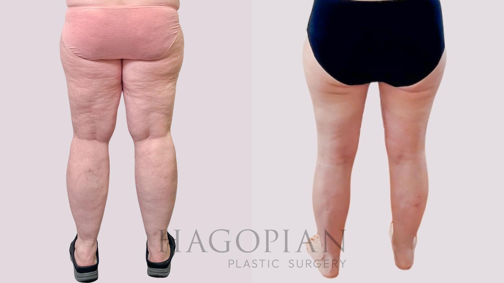 Before & After Thigh Lift Case 259 Back View in Atlanta, GA