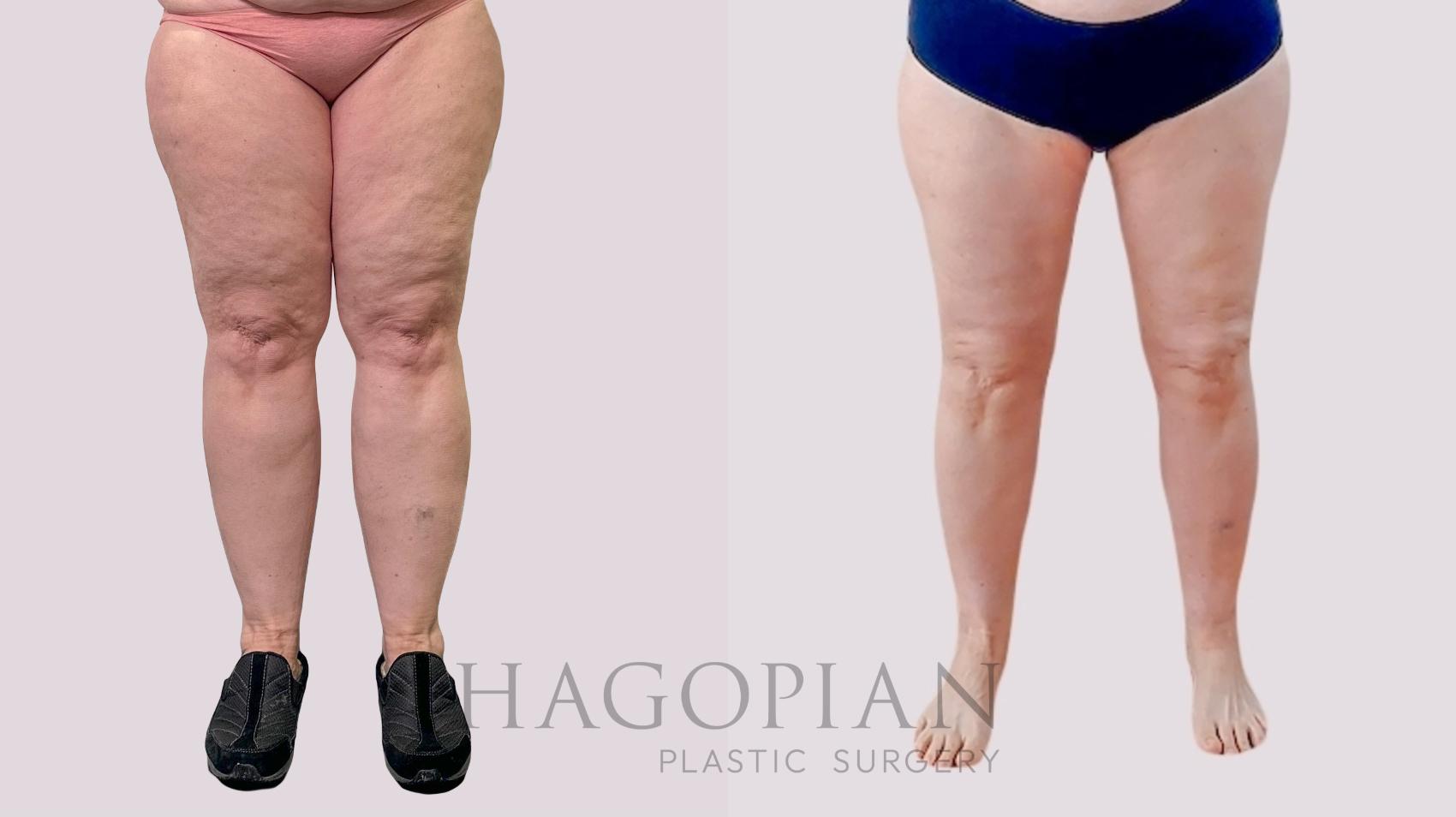 Before & After Thigh Lift Case 259 Front View in Atlanta, GA
