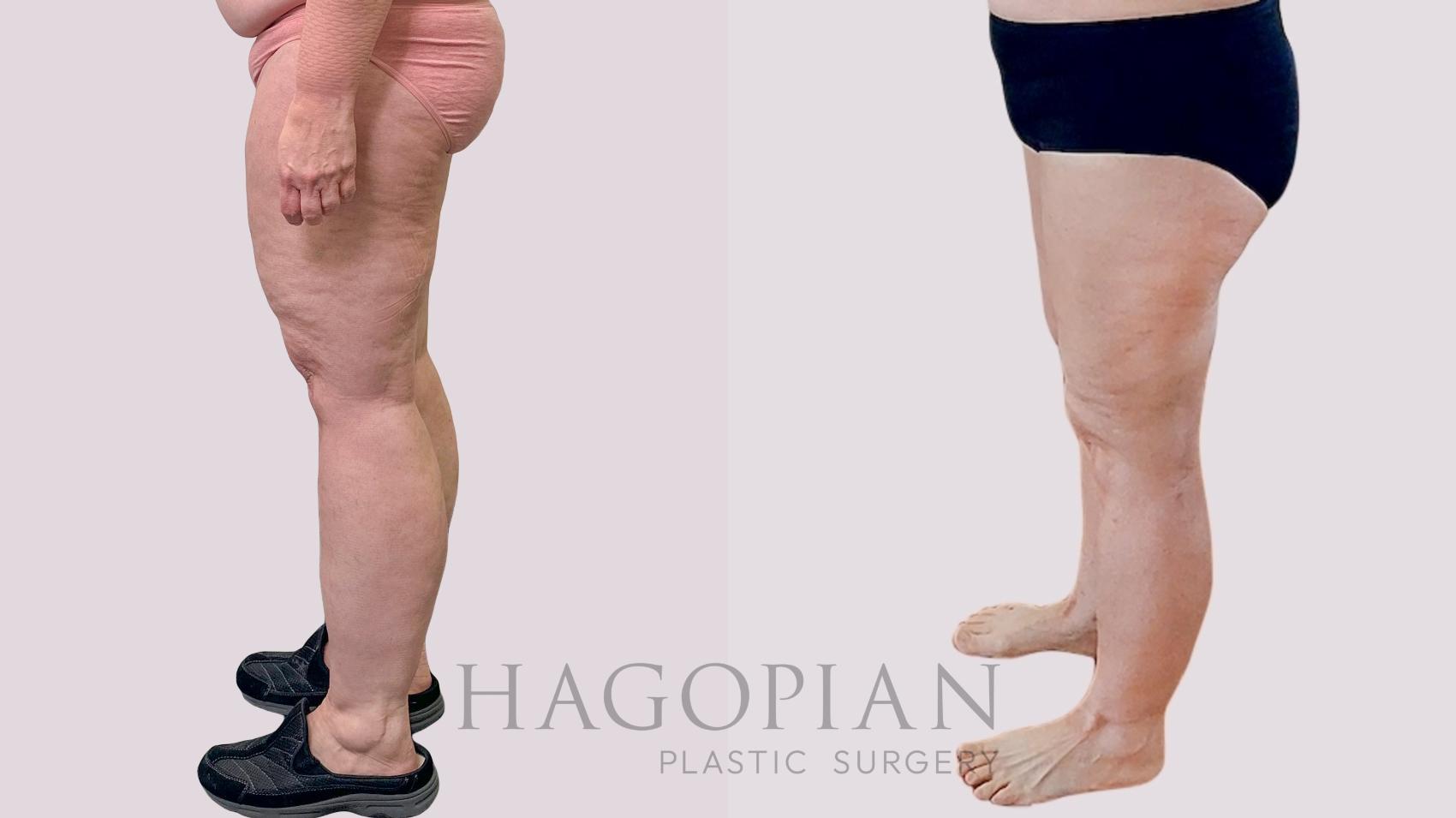 Before & After Thigh Lift Case 259 Left Side View in Atlanta, GA
