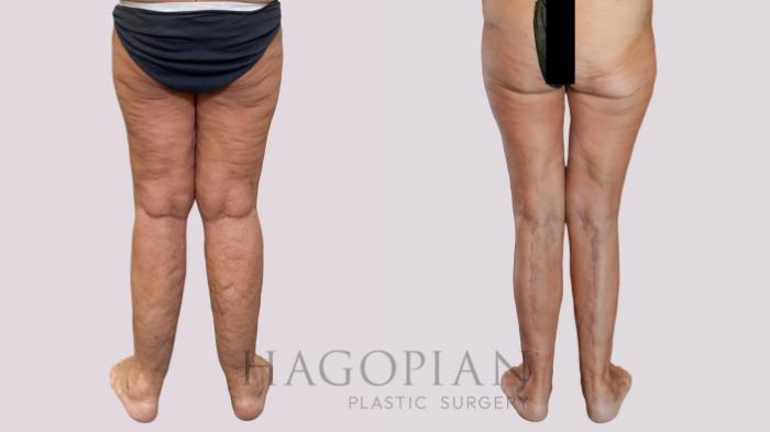 Before & After Thigh Lift Case 261 Back View in Atlanta, GA