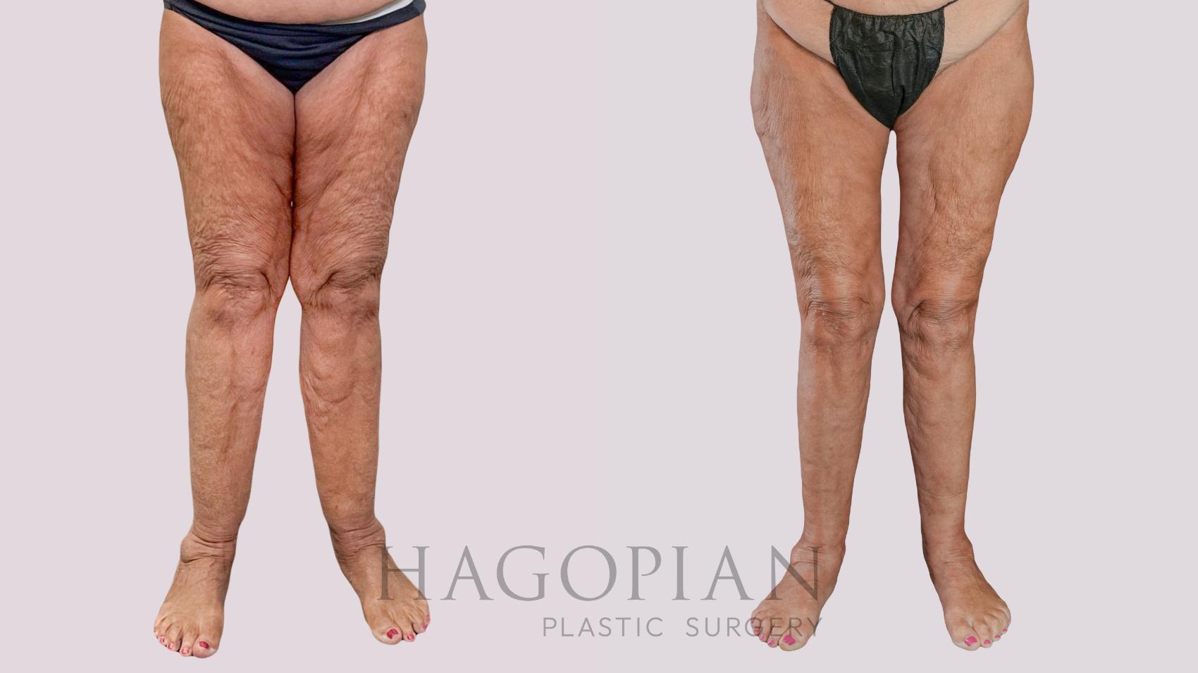 Before & After Thigh Lift Case 261 Front View in Atlanta, GA