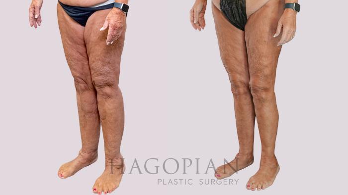 Before & After Thigh Lift Case 261 Left Oblique View in Atlanta, GA